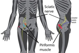 sciatic nerve and piriformis syndrome can cause pain in butt