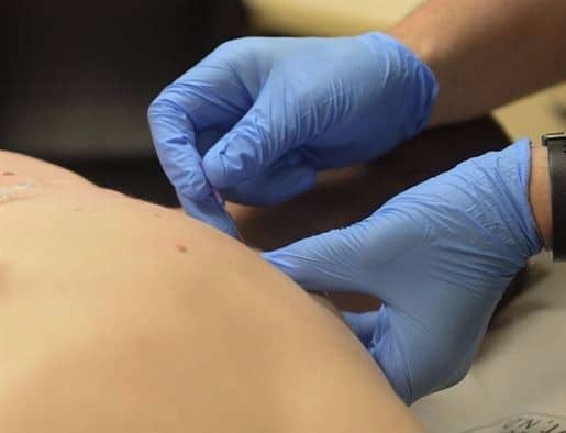 Dry Needling Near Me In St. Louis, MO - More 4 Life Physical Therapy