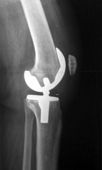 Total Knee Replacement More 4 Life Physical Therapy - St. Louis, MO