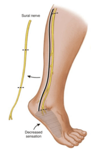 sural nerve can be misdiagnosed as Achilles tendinitis