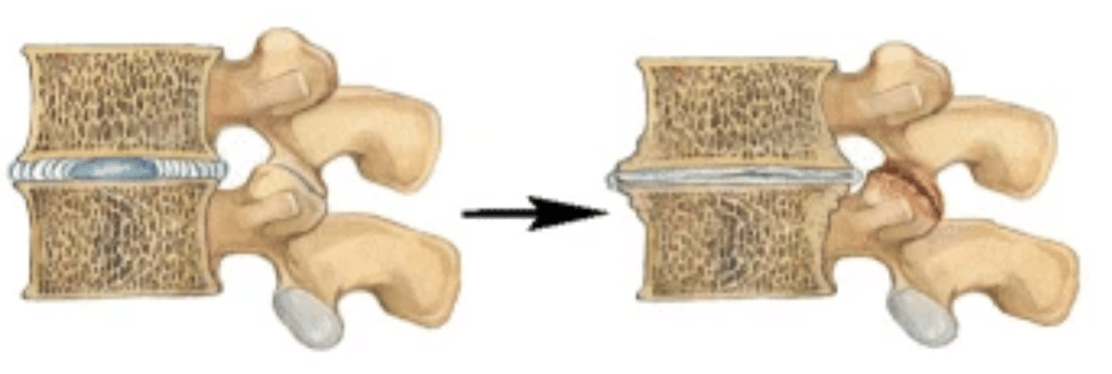 Disc Loss Things To Avoid With Degenerative Disc Disease (plus What To Do)