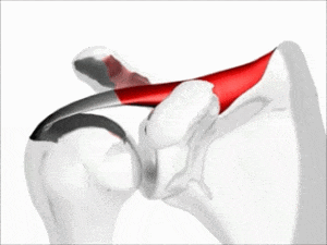 shoulder pain swimming can be caused by pinching the rotator cuff