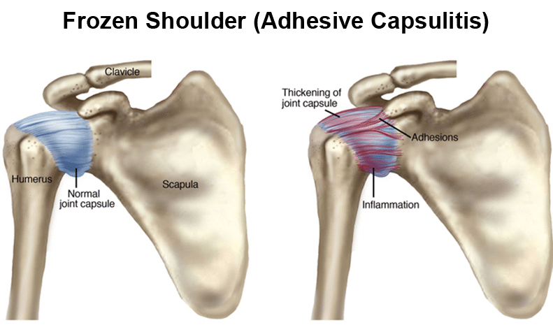 Frozen shoulder causes can include adhesive capulitis. Frozen shoulder treatment includes physical therapy and exercises