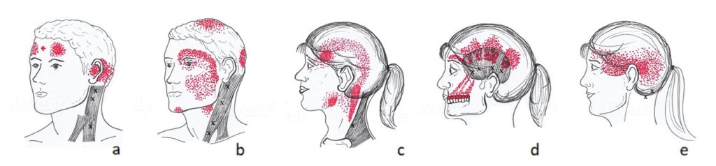 Trigger points: neck pain causing headache