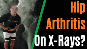 Hip With Arthritis On X Rays