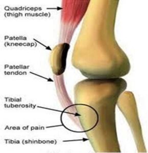 the kneecap or the patellar tendon can cause knee pain with squats