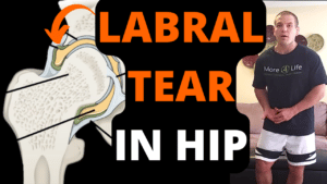 Groin pain from hip labral tear