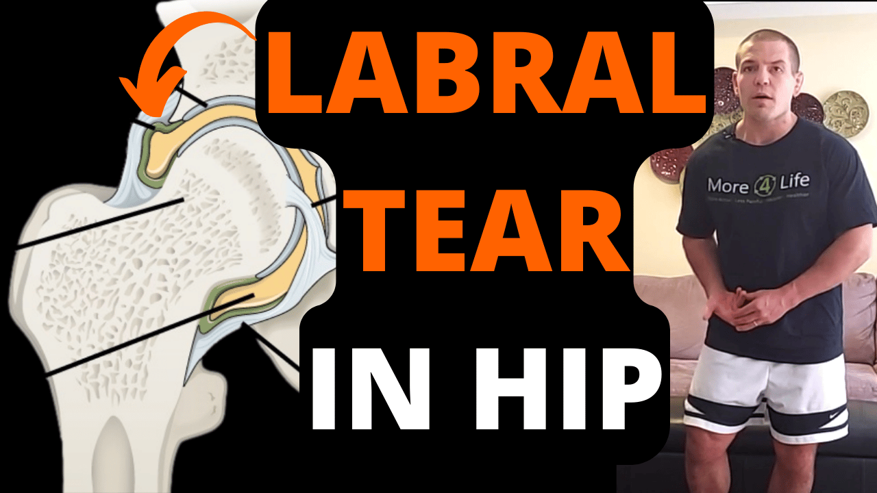 Labral Tear In Hip