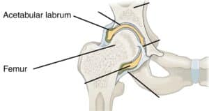 a labral tear in hip is a tear of the acetabular labrum