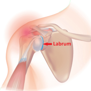 The labrum surrounds the shoulder socket. A labral tear can cause shoulder instability