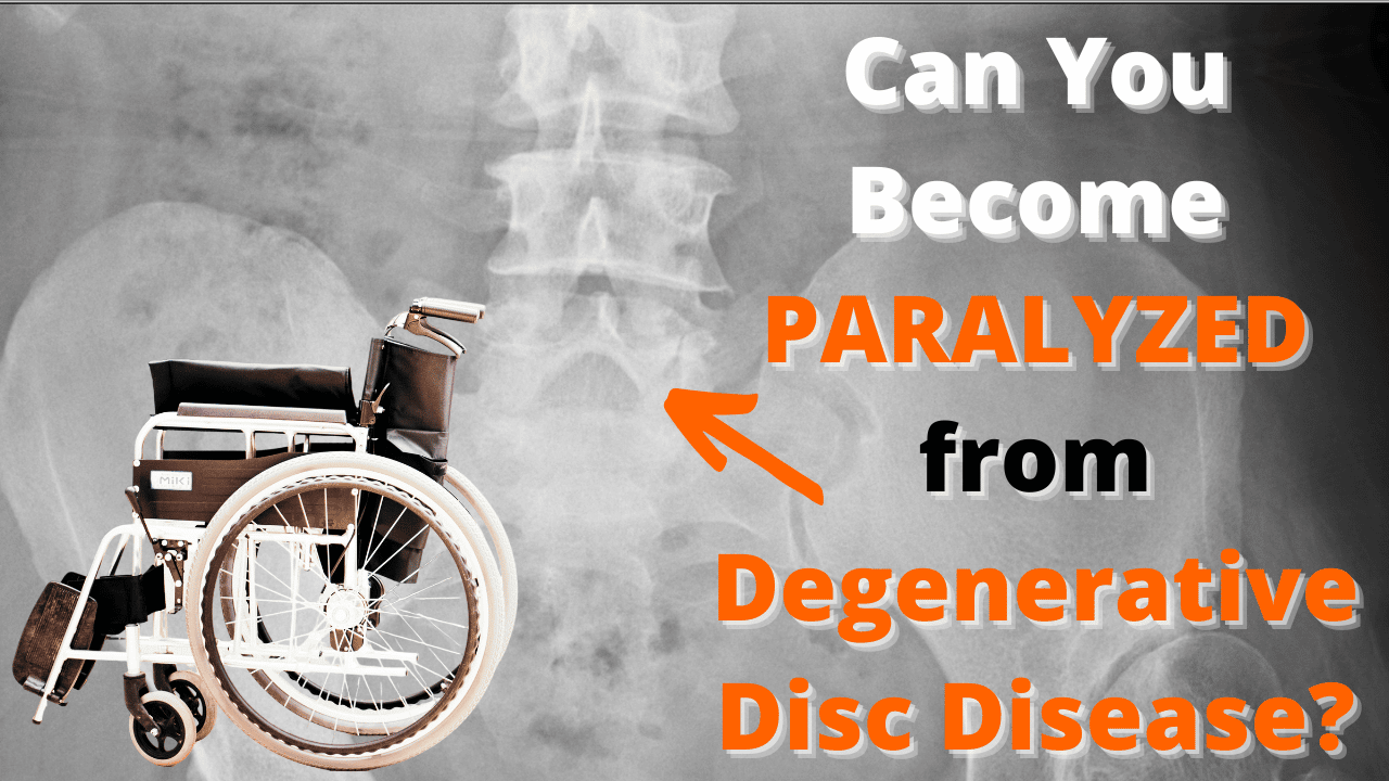 Can you become paralyzed from degenerative disc disease