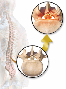 Central Canal Spinal Stenosis Can Cause Walking Problems