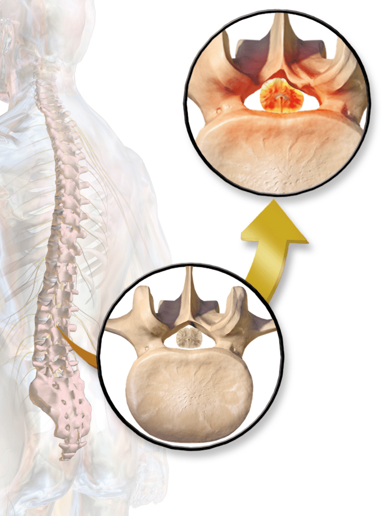 Non-Surgical Treatment for Spinal Stenosis - Huffman Spine Clinic - spinal  stenosis
