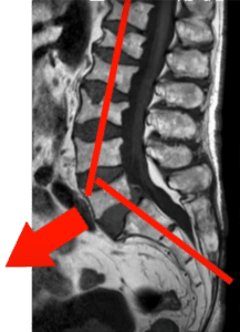 spinal stenosis from spondylolisthesis
