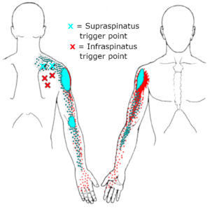 trigger points in the supraspinatus and infraspinatus can cause shoulder pain that radiates down the arm into the fingers.