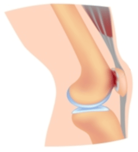 chondromalacia patella can cause knee pain climbing stairs
