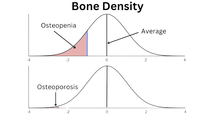 osteopenia vs osteoporosis