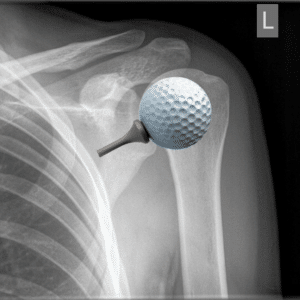 The shoulder joint is like a golf ball sitting on a golf tee
