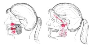 Massetter trigger points can cause headaches from TMJ