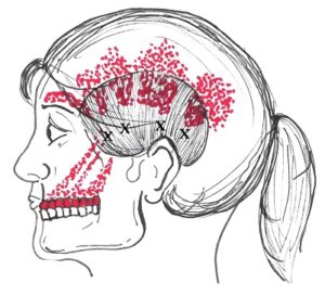 temporalis trigger points can cause headaches from TMJ