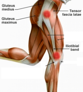 gluteus medius and IT band can cause pain in hip going up stairs