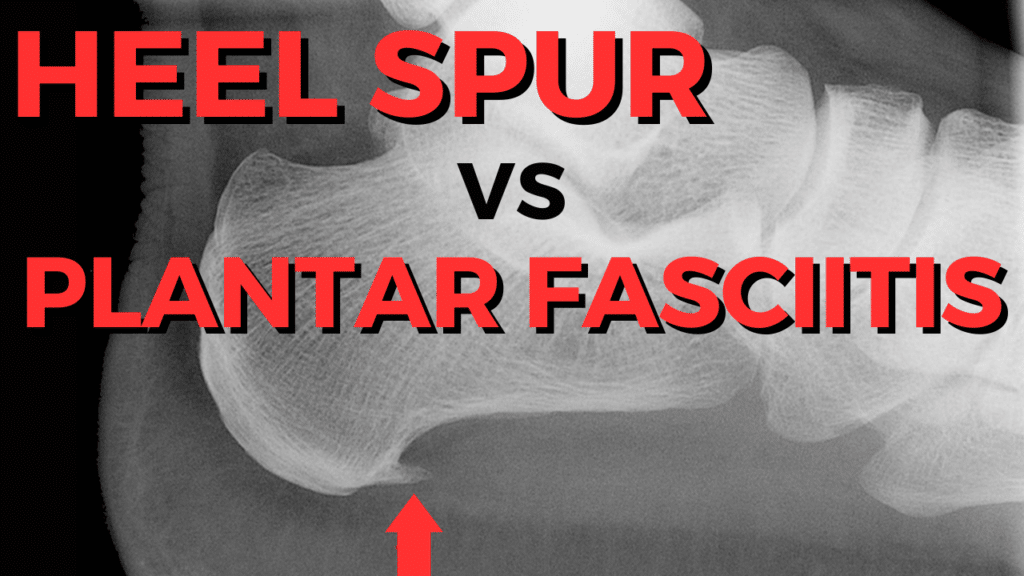 Heel Spur vs Plantar Fasciitis What's The Difference?