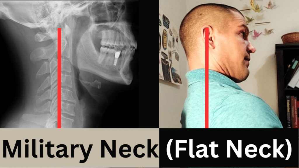 Military Neck (Flat Neck) How To Restore The Curve In Your Neck