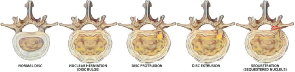 Slipped disc on MRI? Here are the 4 stages of a slipped disc.