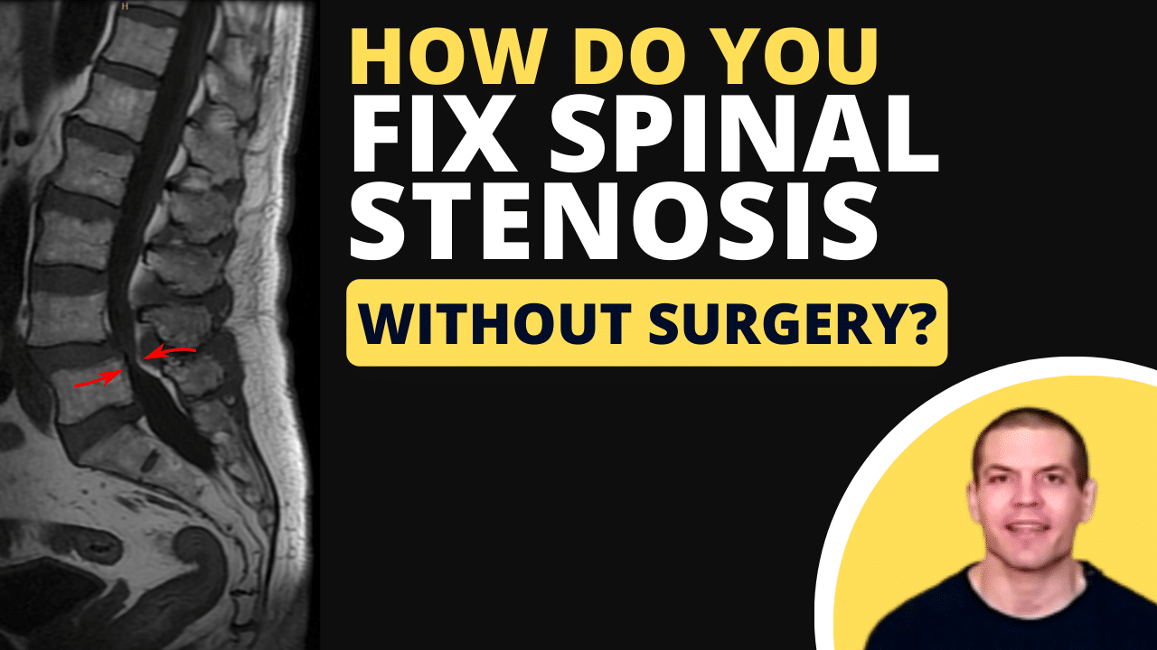 How Do You Fix Spinal Stenosis Without Surgery?