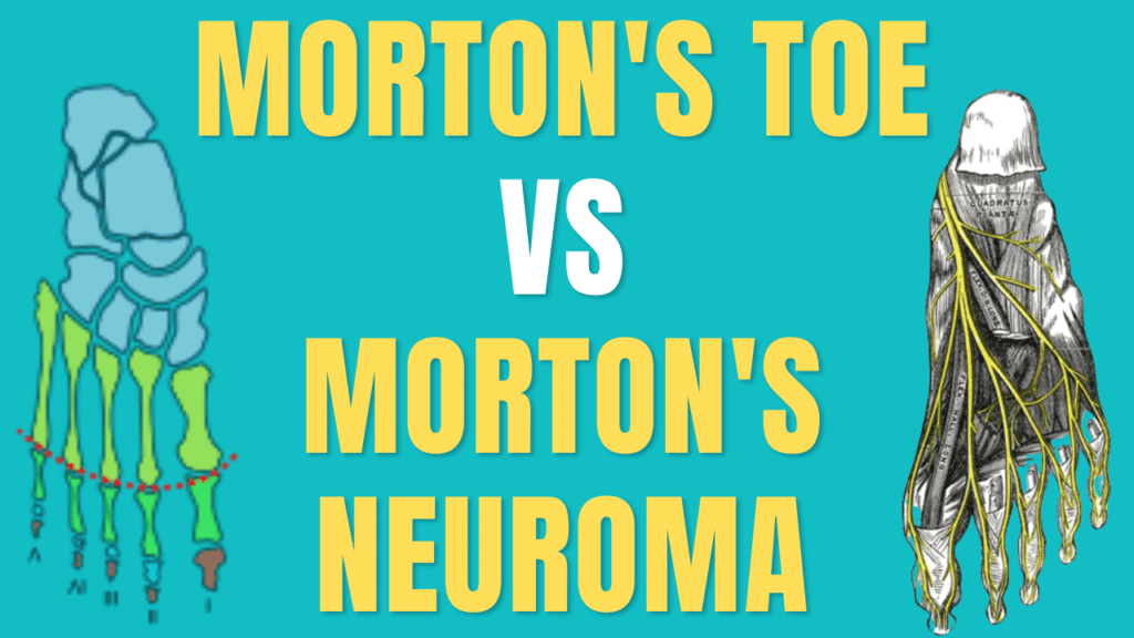 Morton's Toe vs Morton's Neuroma What's The Best Treatment?