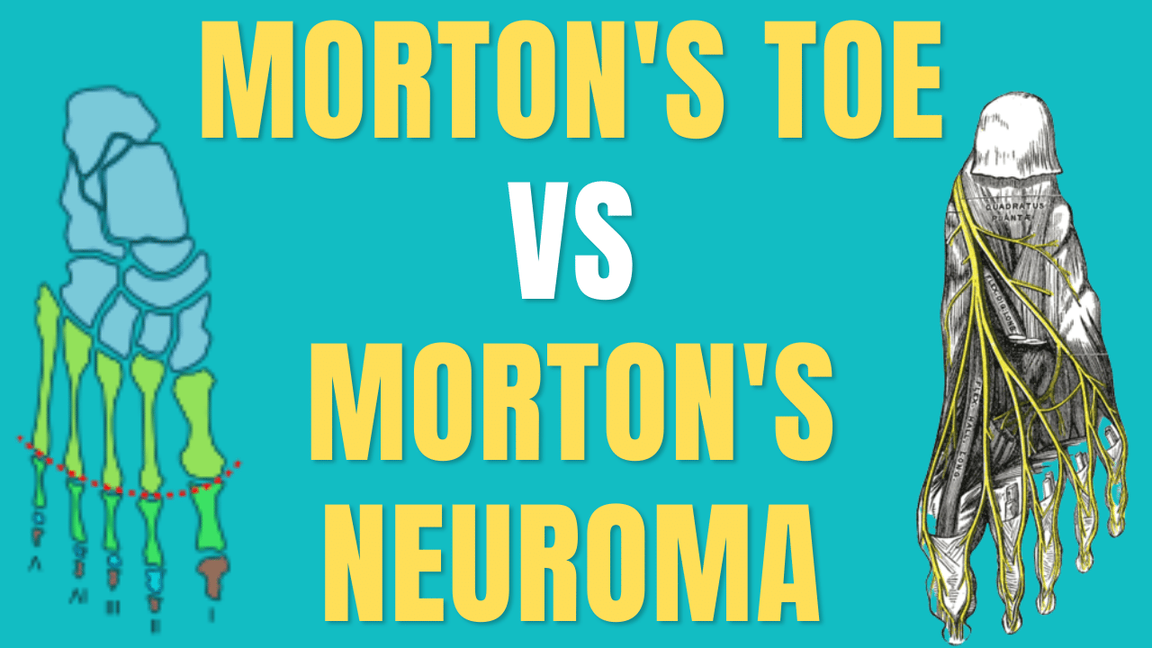 Morton's Toe vs Morton's Neuroma