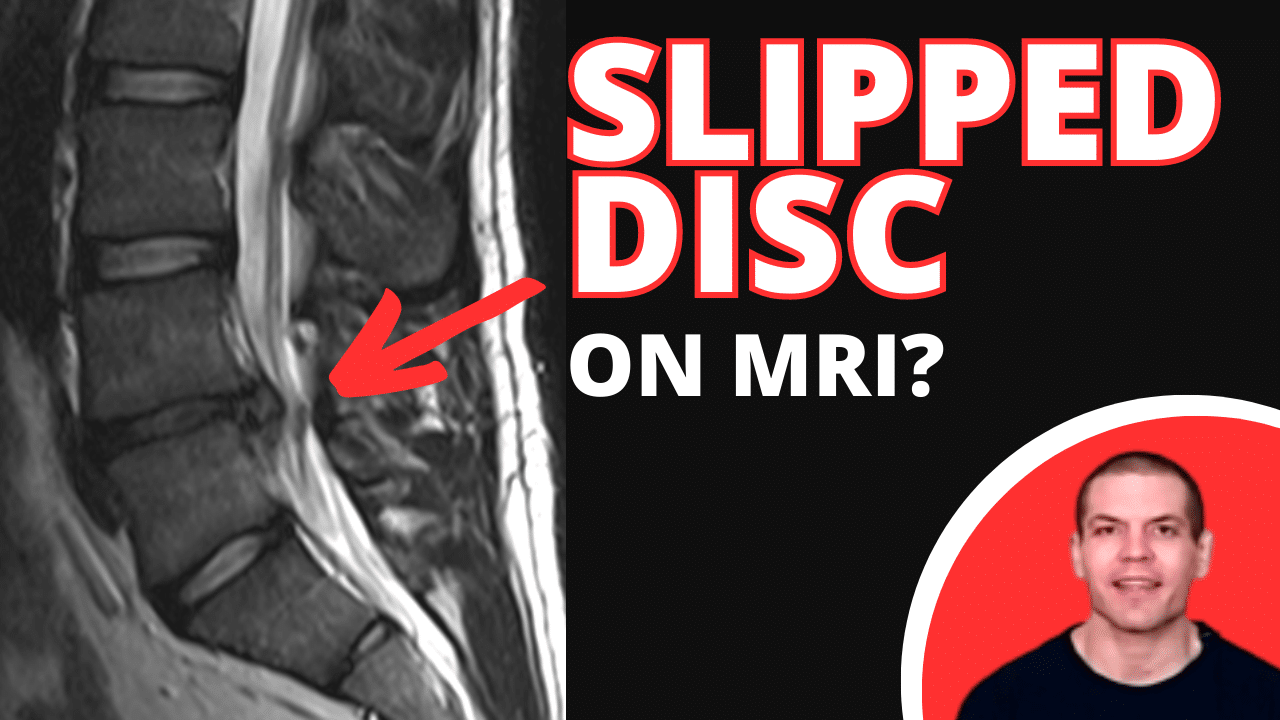 Slipped Disc On MRI
