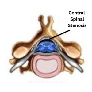 Central Cervical Spinal Stenosis can cause numbness in fingers and tingling in hands