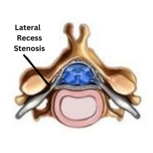 Lateral Recess Cervical Spinal Stenosis