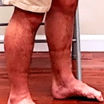 Doming your arch can fix flat feet