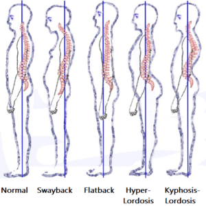 Posture-normal-swayback-flatback-kyphosis-lordosis