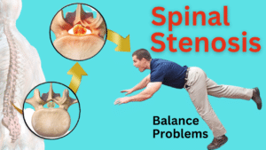 Spinal Stenosis and Balance Problems