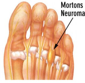 Morton's neuroma can cause ball of foot pain walking
