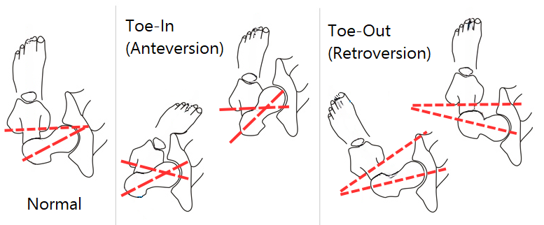 Femoral Anteversion and Retroversion Toe-In and Toe-Out