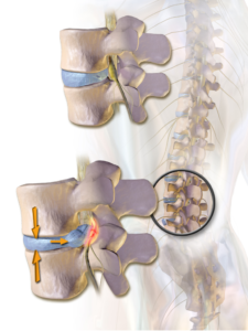A stiff quadratus lumborum can compress the joints, discs, and nerves of the lower back. 