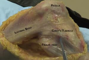Knee Pain from IT band syndrome surgical dissection