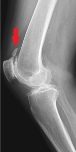 Patellofemoral Degenerative Arthritis bone spur above kneecap