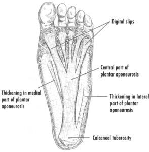 Plantar Fasciitis is only one cause of foot arch pain walking