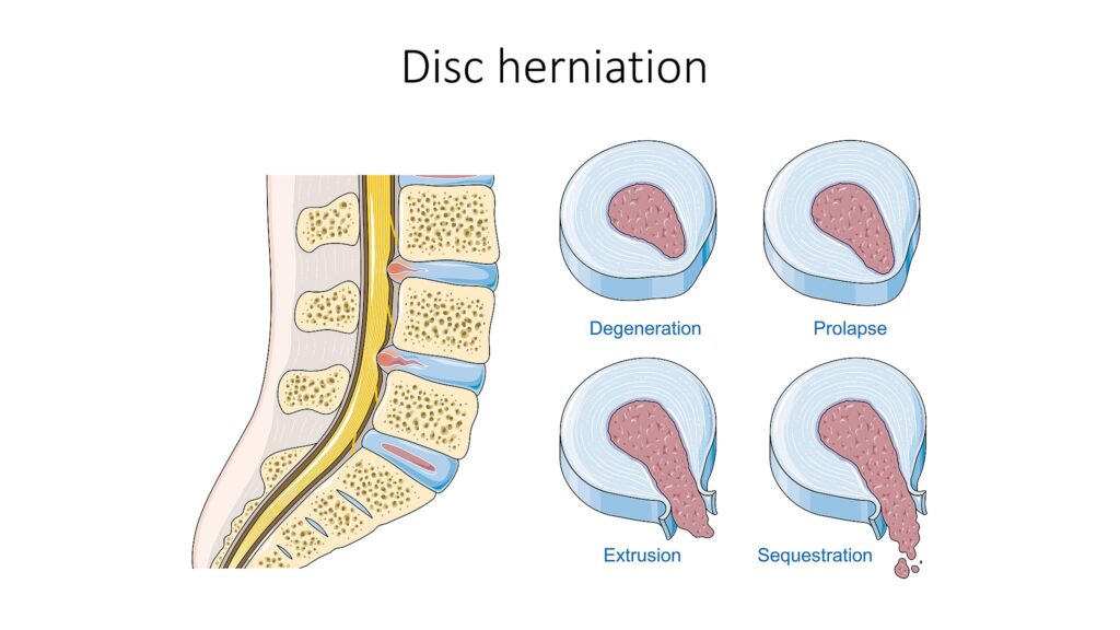 Herniated disc vs disc bulge stages
