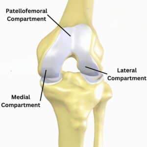 You can have bone on bone knee pain in the medial, lateral, and / or patellofemoral compartments of the knee.