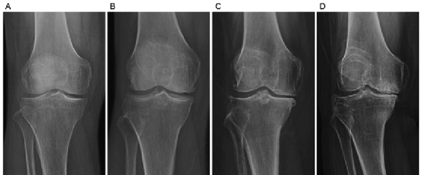 Kellgren-Lawrence Scale Of Knee Arthritis