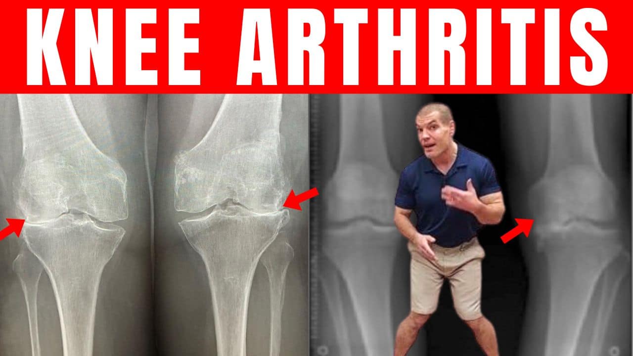 Bowlegged and Knock-Knee Arthritis