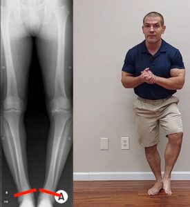 Bowlegged knee arthritis changes ankle axis