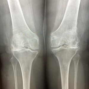 Lateral Knee Arthritis Valgus