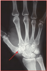 Osteoarthritis in Thumb CMC Joint